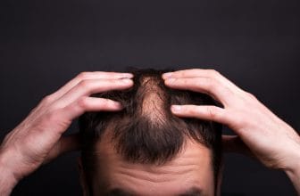 caderea parului alopecie
